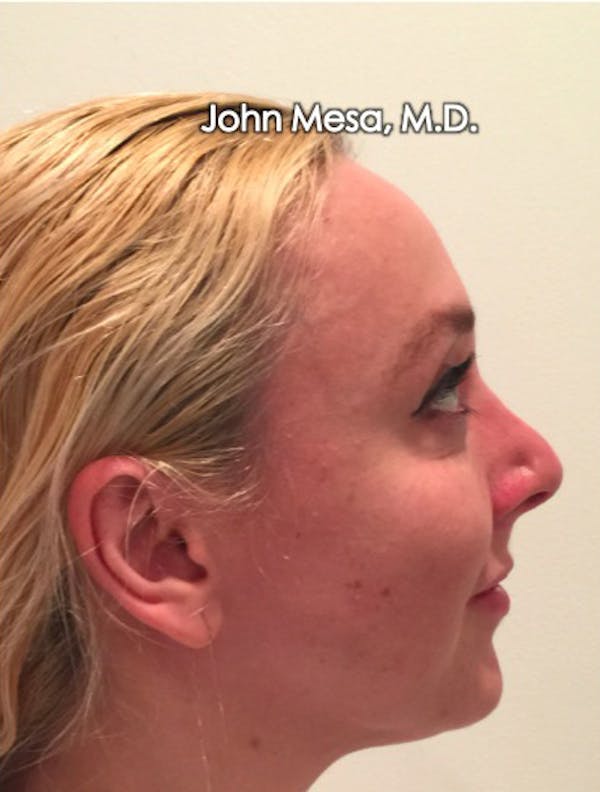 Botox Before & After Gallery - Patient 6371562 - Image 16