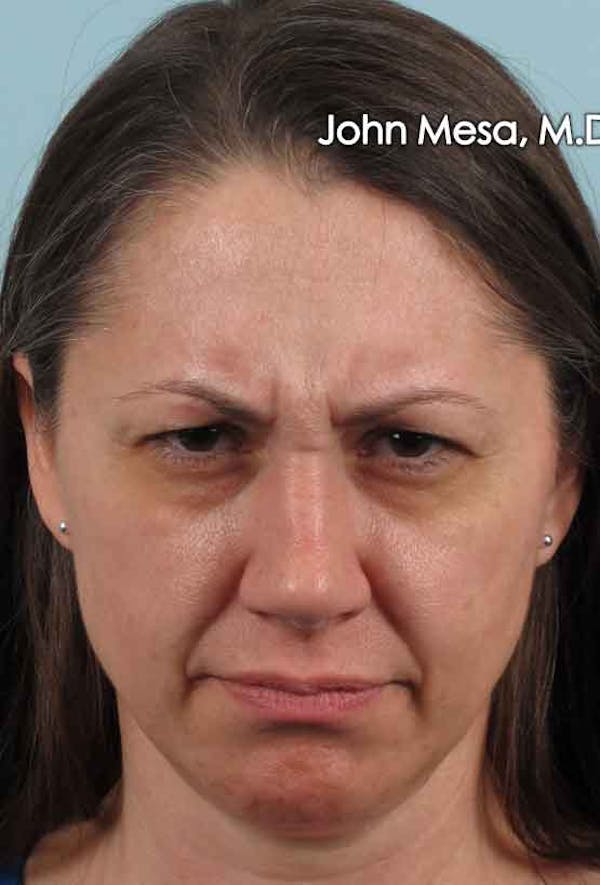BOTOX Before & After Gallery - Patient 6371564 - Image 3