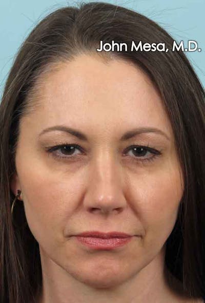 BOTOX Before & After Gallery - Patient 6371564 - Image 4