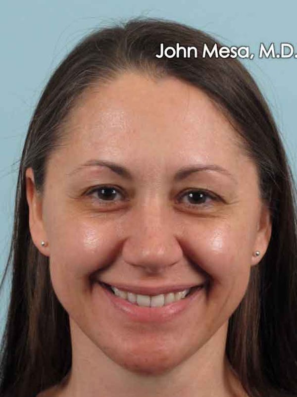 BOTOX Before & After Gallery - Patient 6371564 - Image 5