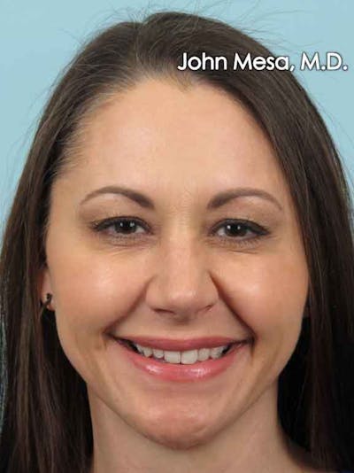 BOTOX Before & After Gallery - Patient 6371564 - Image 6