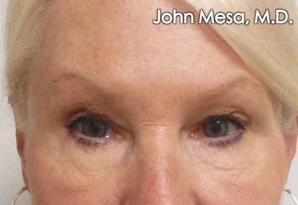 BOTOX Before & After Gallery - Patient 6371567 - Image 1