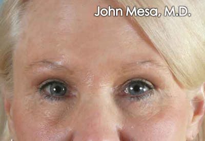 Botox Before & After Gallery - Patient 6371567 - Image 2