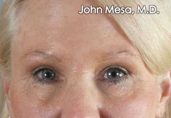 BOTOX Before & After Gallery - Patient 6371567 - Image 2