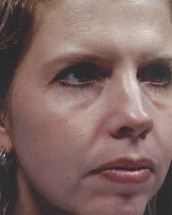 Obagi Nu Derm 2 Before & After Gallery - Patient 6371568 - Image 2