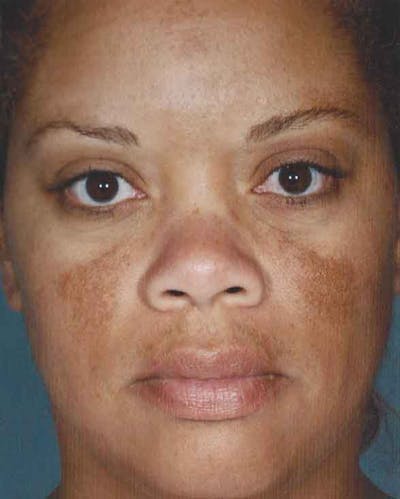 Obagi Nu Derm 2 Before & After Gallery - Patient 6371571 - Image 1