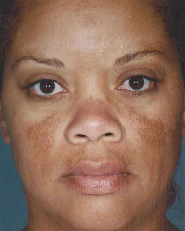 Obagi Nu Derm 2 Before & After Gallery - Patient 6371571 - Image 1