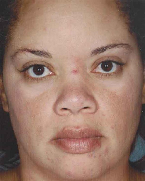 Obagi Nu Derm 2 Before & After Gallery - Patient 6371571 - Image 2