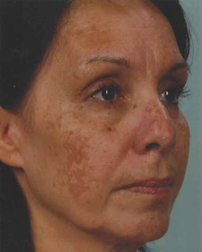 Obagi Nu Derm 2 Before & After Gallery - Patient 6371574 - Image 1
