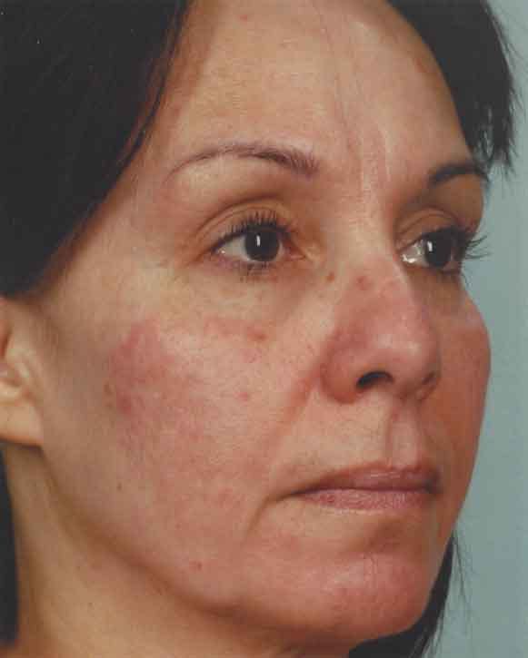 Obagi Nu Derm 2 Before & After Gallery - Patient 6371574 - Image 2