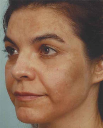 Obagi Nu Derm 2 Before & After Gallery - Patient 6371576 - Image 1