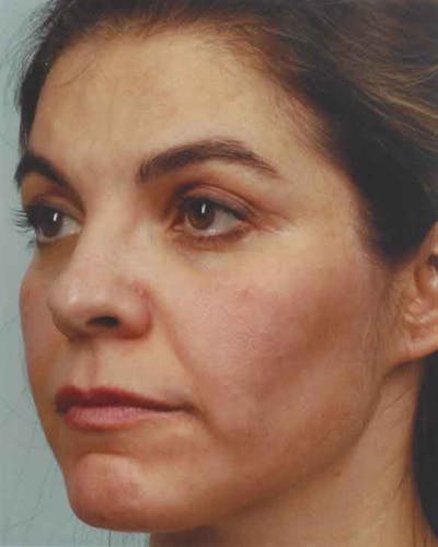 Obagi Nu Derm 2 Before & After Gallery - Patient 6371576 - Image 2