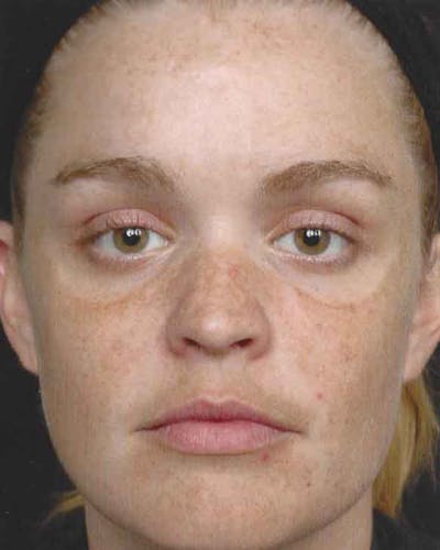 Obagi Nu Derm 2 Before & After Gallery - Patient 6371577 - Image 1