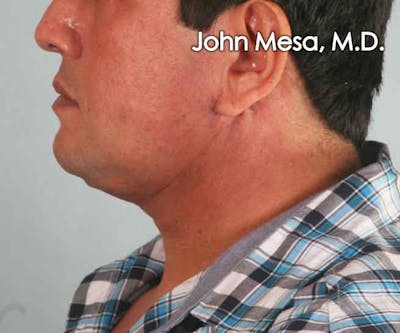 Neck Lift Before & After Gallery - Patient 6371579 - Image 2