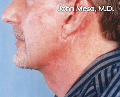 Neck Lift Before & After Gallery - Patient 6371581 - Image 2