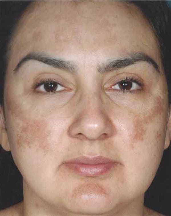 Obagi Nu Derm 2 Before & After Gallery - Patient 6371582 - Image 1