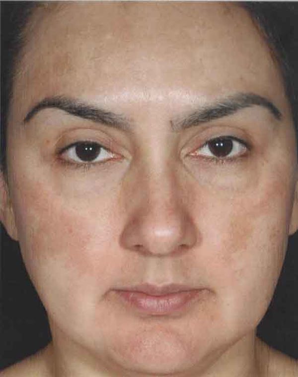 Obagi Nu Derm 2 Before & After Gallery - Patient 6371582 - Image 2