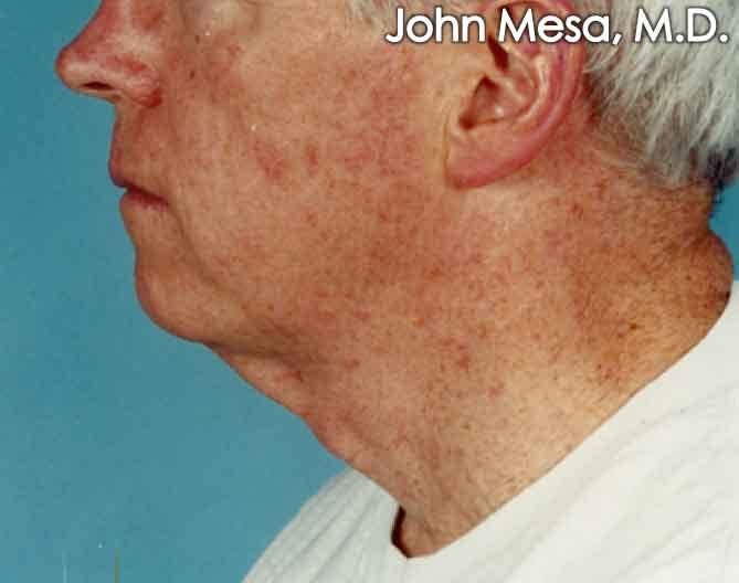 Neck Lift Before & After Gallery - Patient 6371583 - Image 1