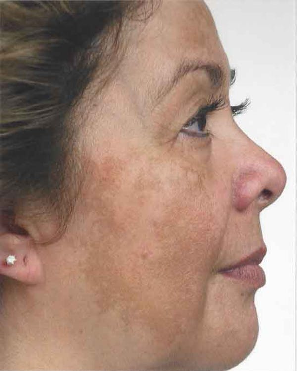 Obagi Nu Derm 2 Before & After Gallery - Patient 6371585 - Image 1