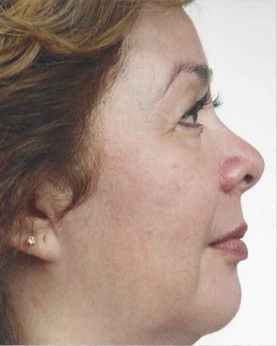 Obagi Nu Derm 2 Before & After Gallery - Patient 6371585 - Image 2