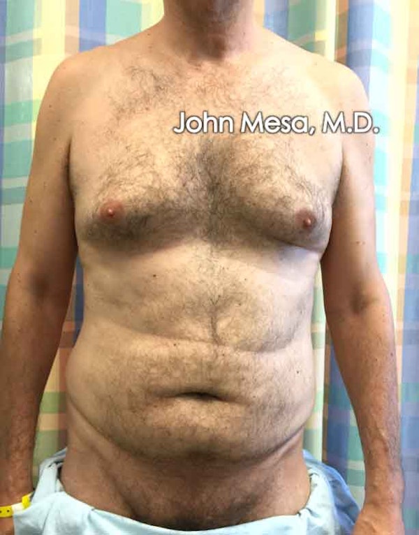 Liposuction for Men