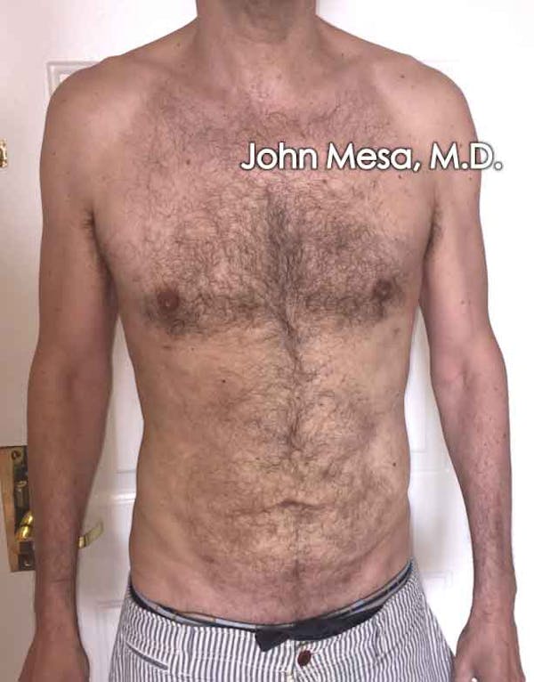 Liposuction Before & After Gallery - Patient 6371586 - Image 2