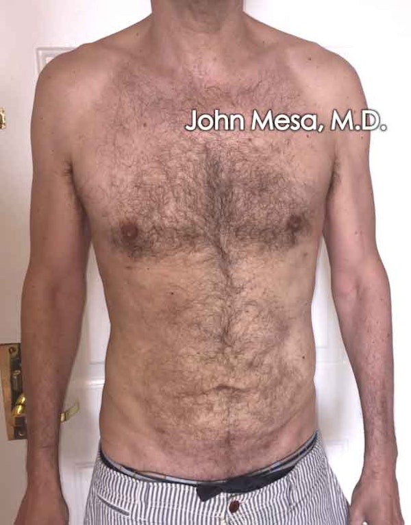Liposuction for Men