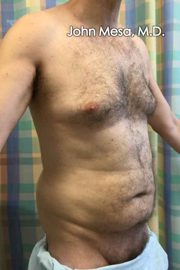 Liposuction Before & After Gallery - Patient 6371586 - Image 3