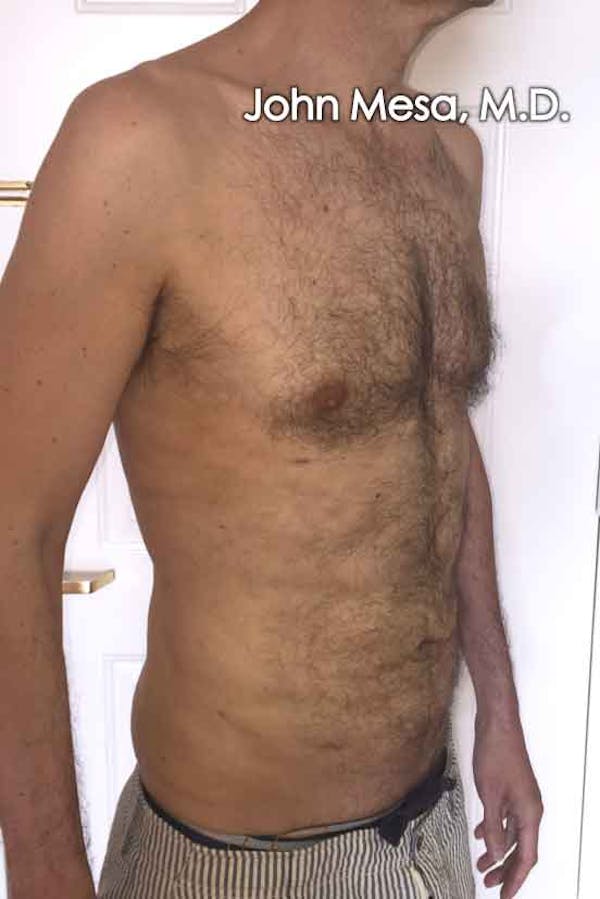 Liposuction Gallery - Patient 6371586 - Image 4