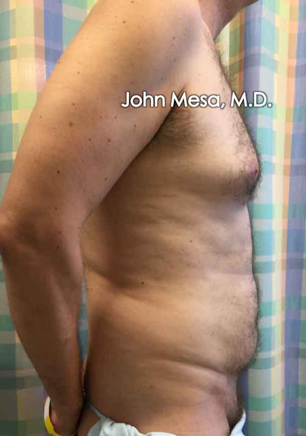 Liposuction Before & After Gallery - Patient 6371586 - Image 5