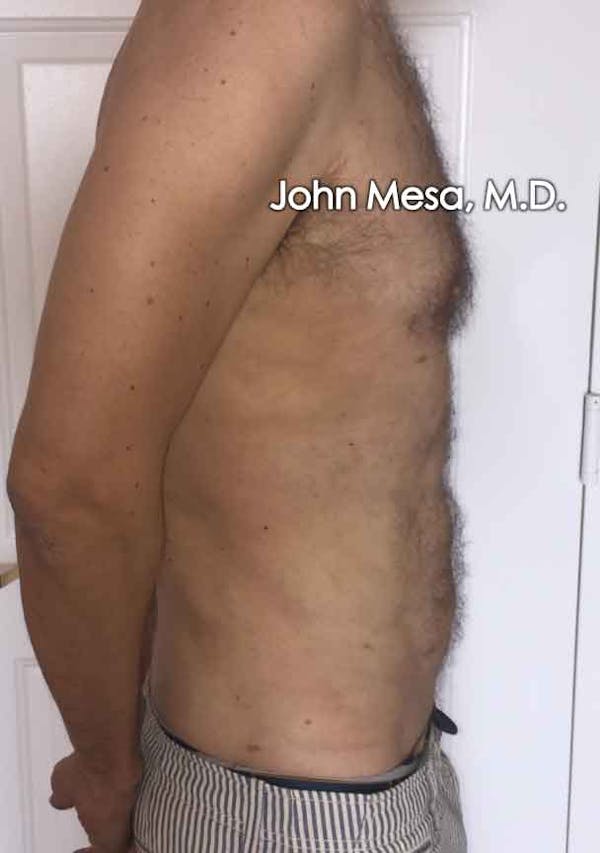 Liposuction Before & After Gallery - Patient 6371586 - Image 6