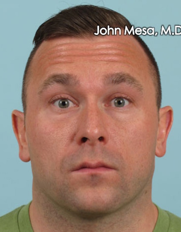 BOTOX for Men