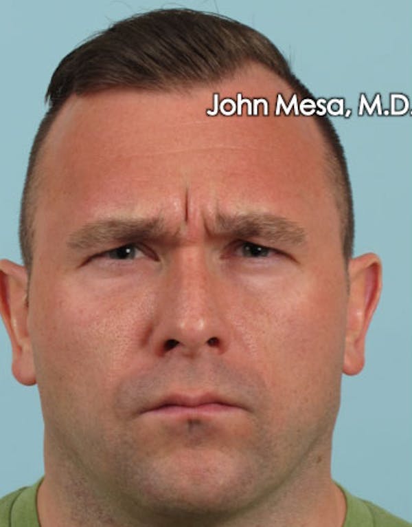 Botox Before & After Gallery - Patient 6371635 - Image 3