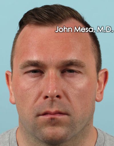 Botox Before & After Gallery - Patient 6371635 - Image 4