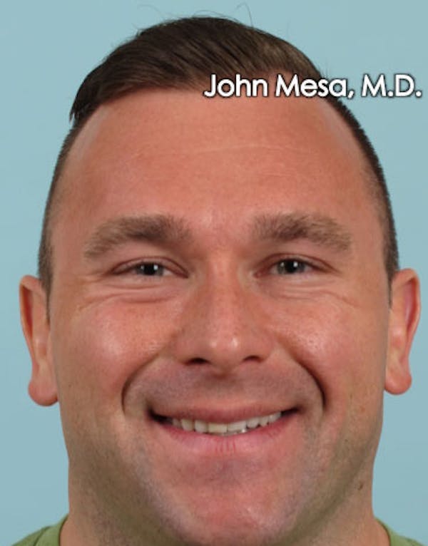 Botox Before & After Gallery - Patient 6371635 - Image 5
