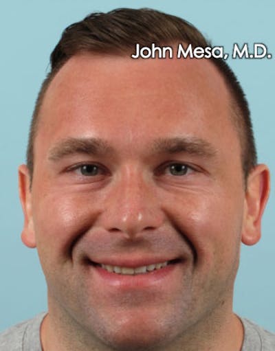 Botox Before & After Gallery - Patient 6371635 - Image 6