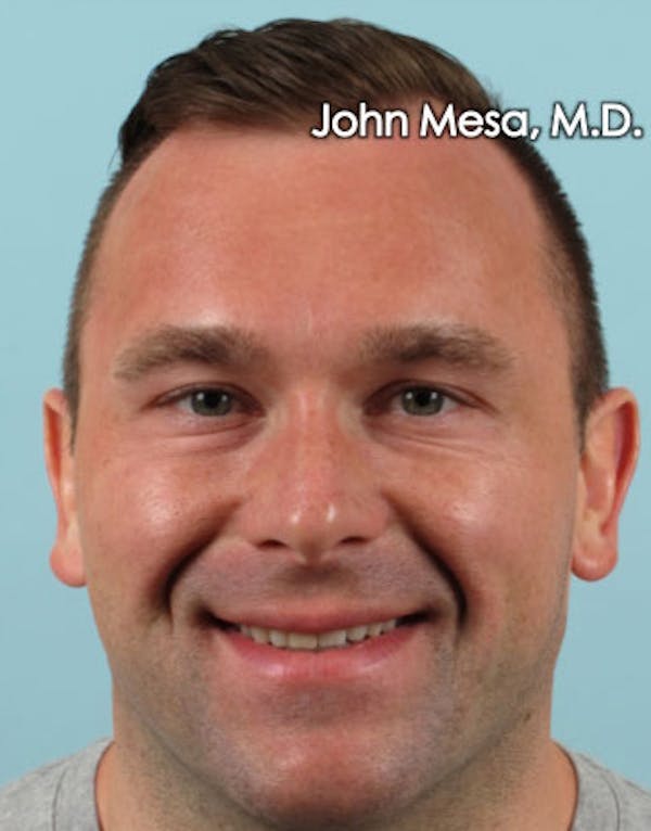 Botox Before & After Gallery - Patient 6371635 - Image 6