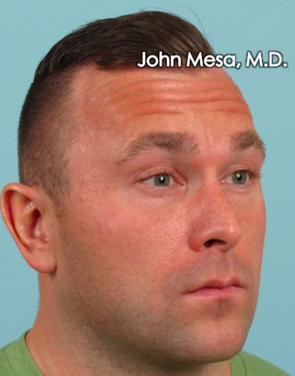 Botox Before & After Gallery - Patient 6371635 - Image 7