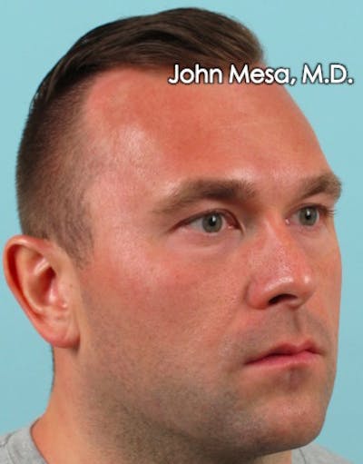 Botox Before & After Gallery - Patient 6371635 - Image 8