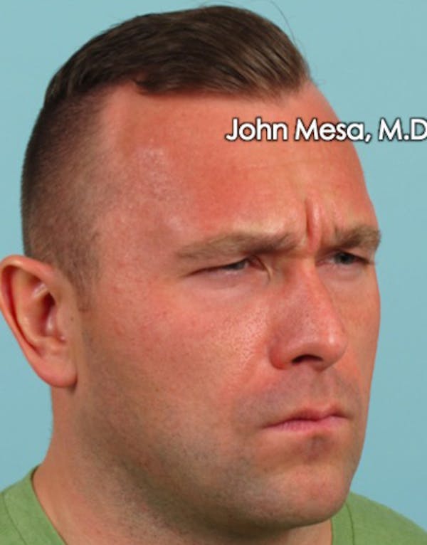 Botox Before & After Gallery - Patient 6371635 - Image 9