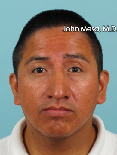 Botox Before & After Gallery - Patient 6371639 - Image 1