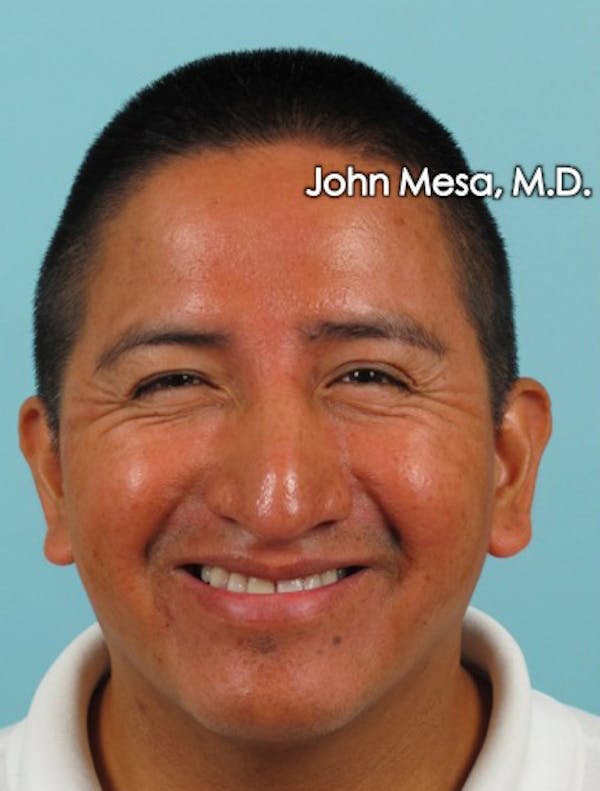 BOTOX Before & After Gallery - Patient 6371639 - Image 3