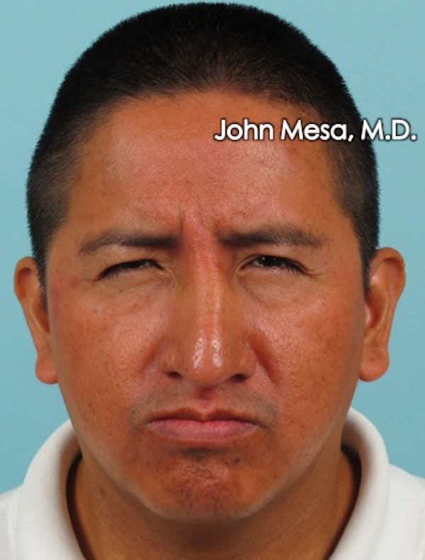 BOTOX Before & After Gallery - Patient 6371639 - Image 5