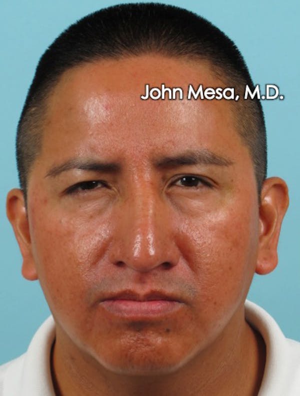 BOTOX Before & After Gallery - Patient 6371639 - Image 6