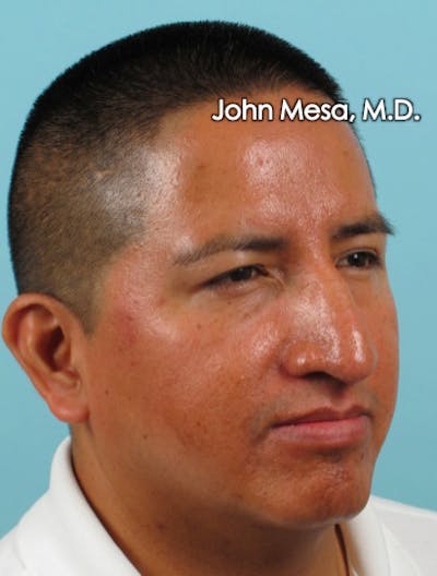 BOTOX Before & After Gallery - Patient 6371639 - Image 8