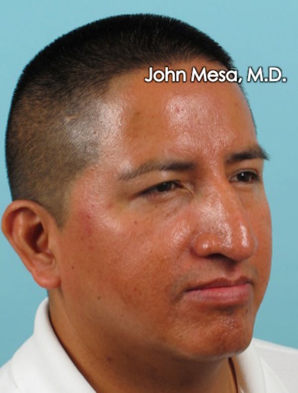 BOTOX Before & After Gallery - Patient 6371639 - Image 8