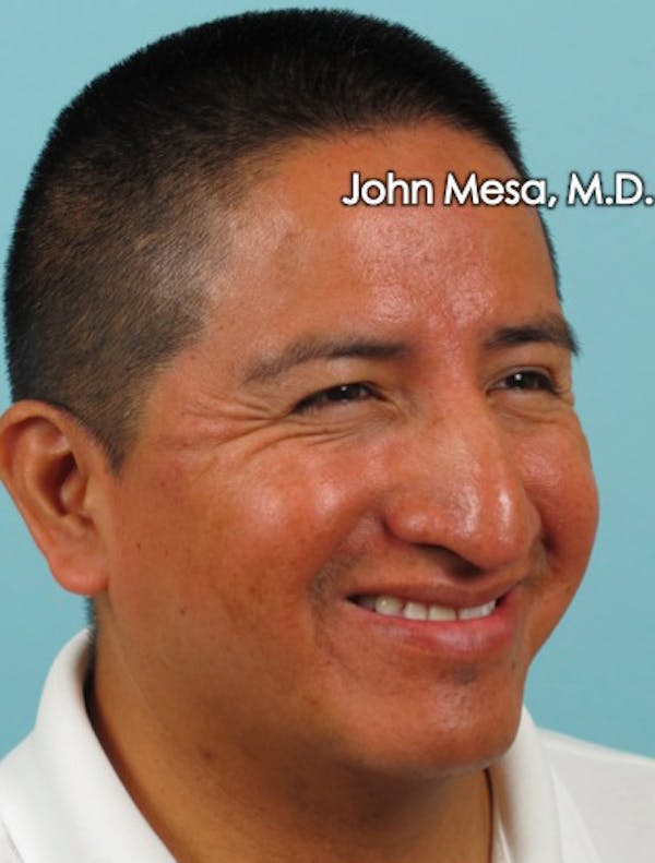 BOTOX Before & After Gallery - Patient 6371639 - Image 9