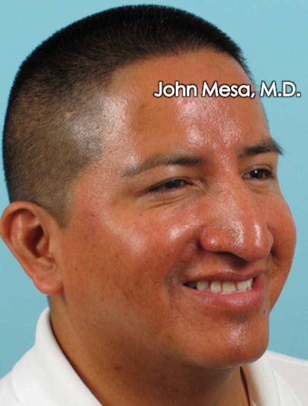 BOTOX Before & After Gallery - Patient 6371639 - Image 10
