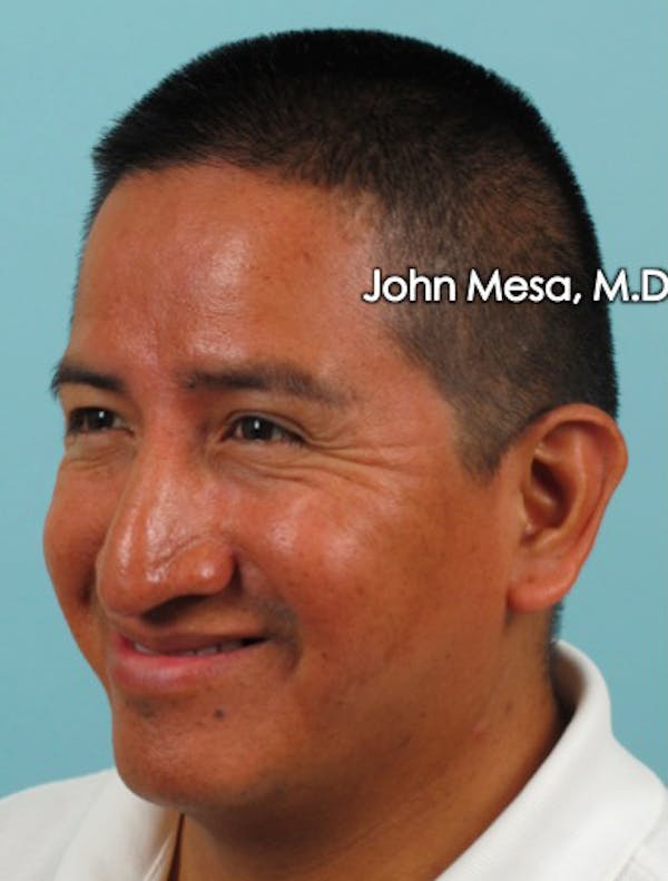 BOTOX Before & After Gallery - Patient 6371639 - Image 11