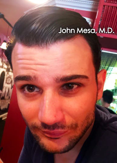 Botox Before & After Gallery - Patient 6371643 - Image 1
